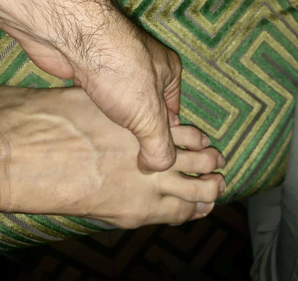 Tratamiento de fisioterapia para edema óseo